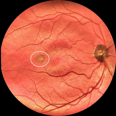 sg-laserscanning-ophthalmoskop-lso-naevus-oder-ablatio-mit-markierung